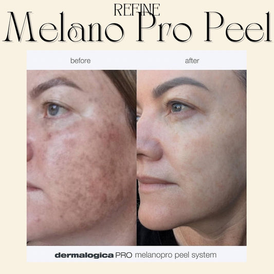 Treating Hyperpigmentation (Even Melasma) with Dermalogica’s NEW Melano Pro Peel