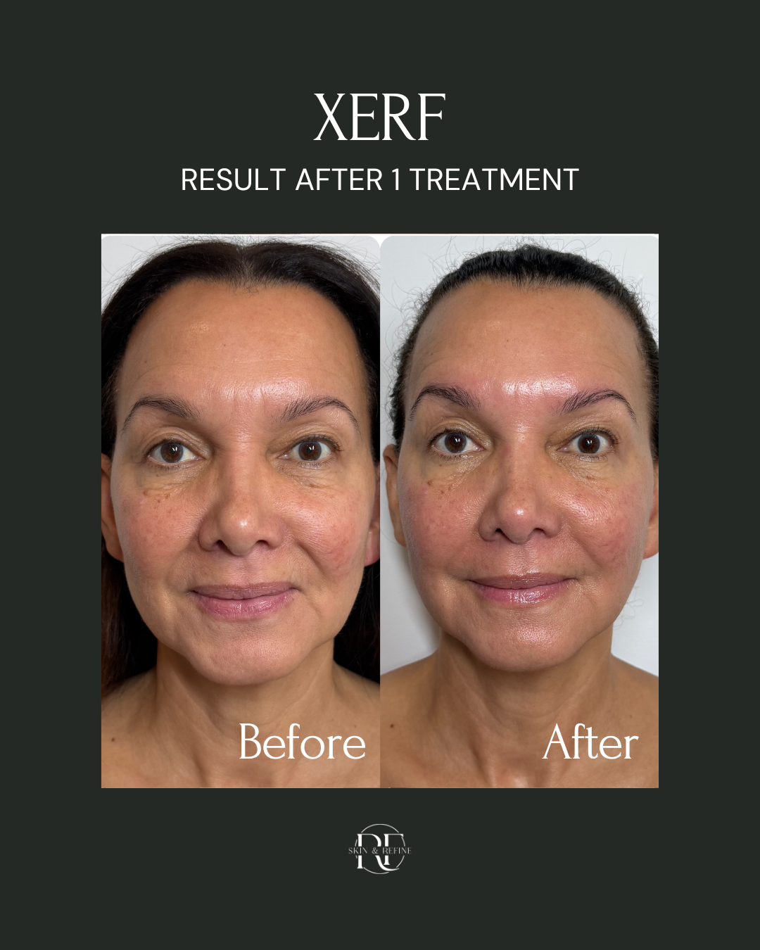 Xerf Radiofrquency Structural Skin Tightening Treatment