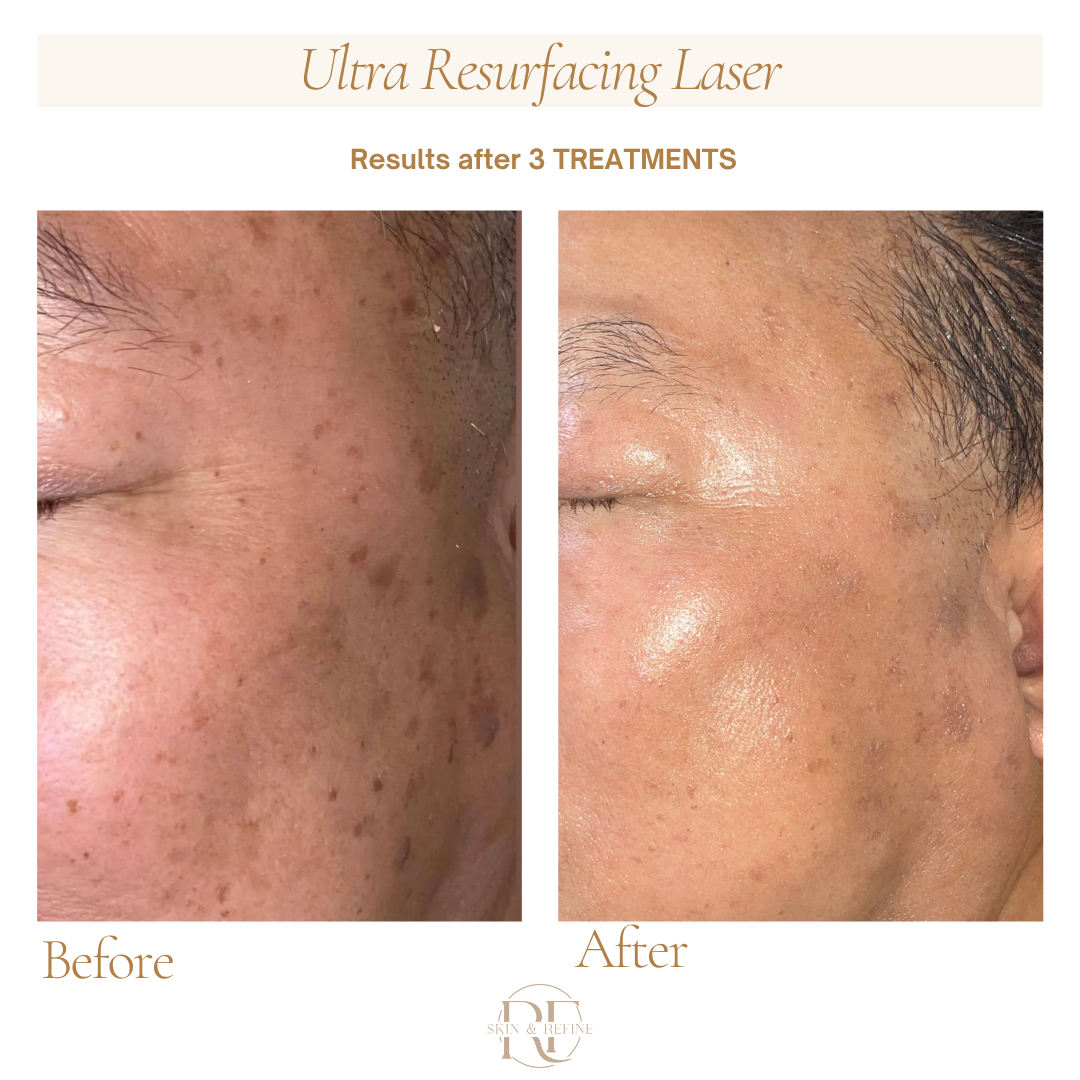 Ultra Laser - Hair Restoration / Pigmentation 1st-Client Offer