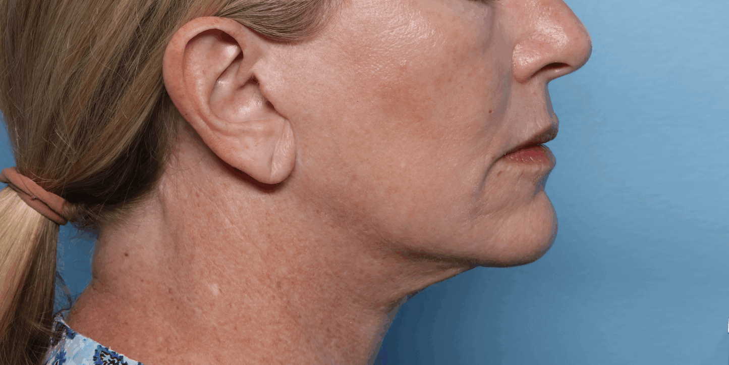 XERF Radiofrequency Structural Skin Tightening Treatment