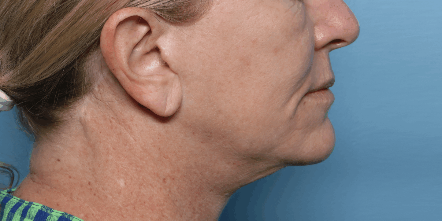 XERF Radiofrequency Structural Skin Tightening Treatment