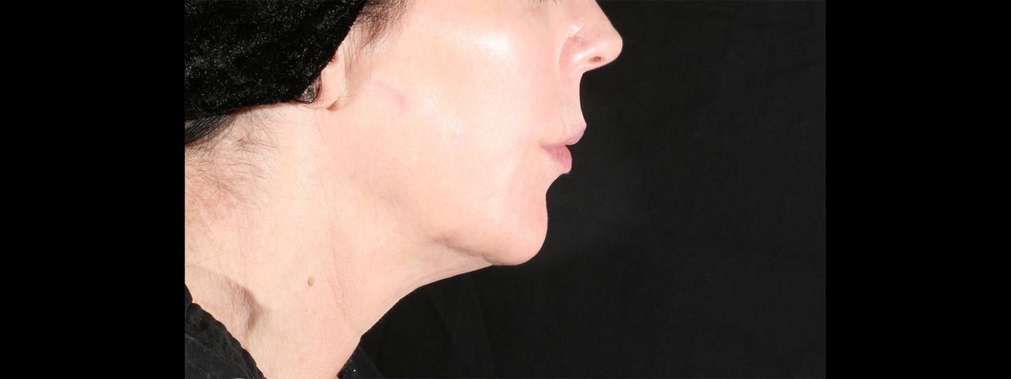 XERF Radiofrequency Structural Skin Tightening Treatment