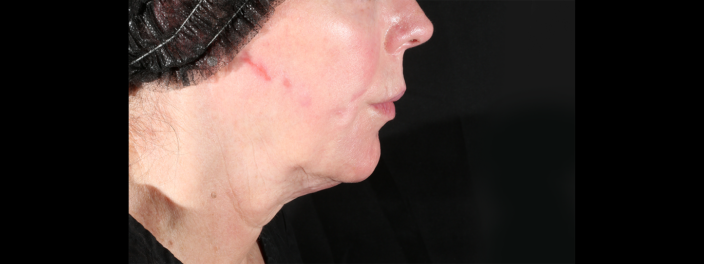 XERF Radiofrequency Structural Skin Tightening Treatment